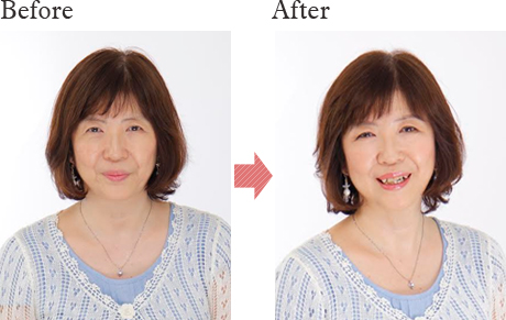before after
